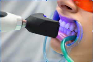 teeth whitening wimbledon